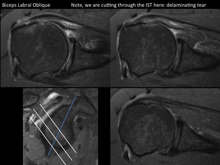 Figure 4 for case tendon of rotator cuff ( RID1948 )